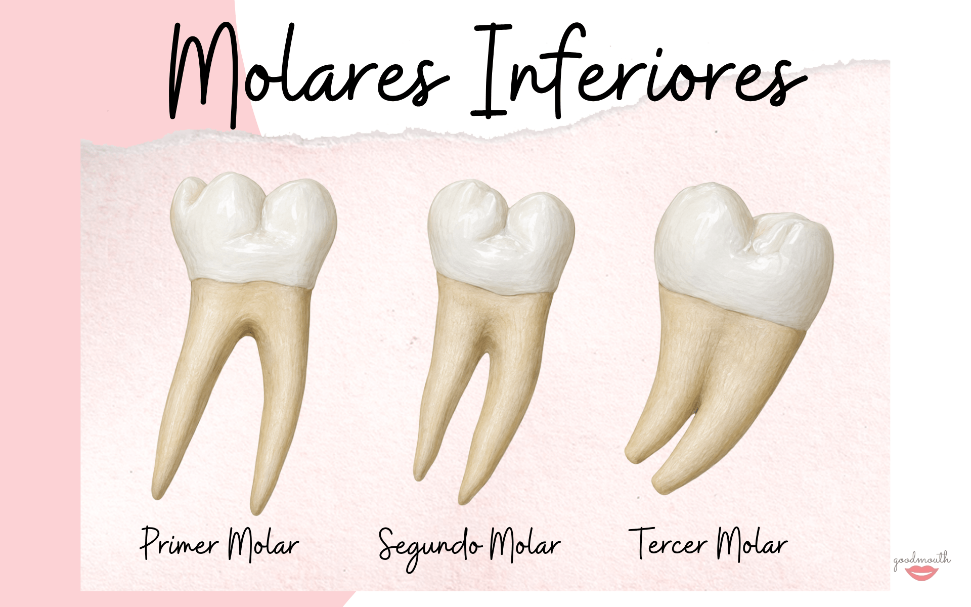Molares Inferiores